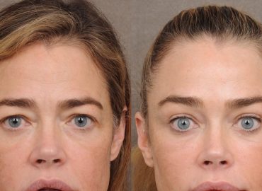Denise Richards Opens Up About Her Facelift Experience