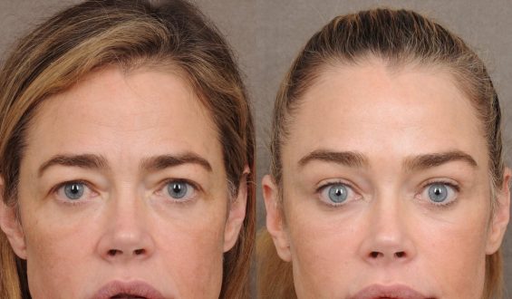 Denise Richards Opens Up About Her Facelift Experience