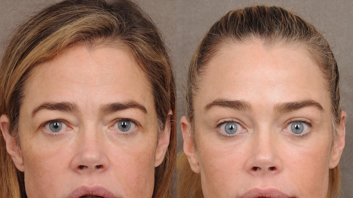 Denise Richards Opens Up About Her Facelift Experience