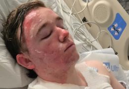 McDonald’s Employee Suffers Severe Burns in Alleged Hot Oil Attack