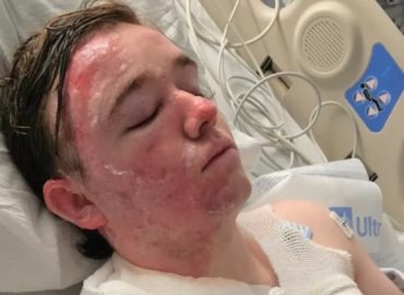 McDonald’s Employee Suffers Severe Burns in Alleged Hot Oil Attack