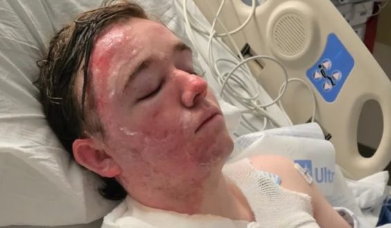 McDonald’s Employee Suffers Severe Burns in Alleged Hot Oil Attack