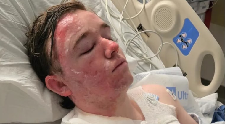 McDonald’s Employee Suffers Severe Burns in Alleged Hot Oil Attack