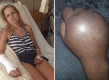 Facing Life with CRPS: A Journey of Resilience