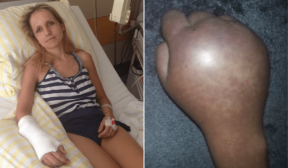 Facing Life with CRPS: A Journey of Resilience