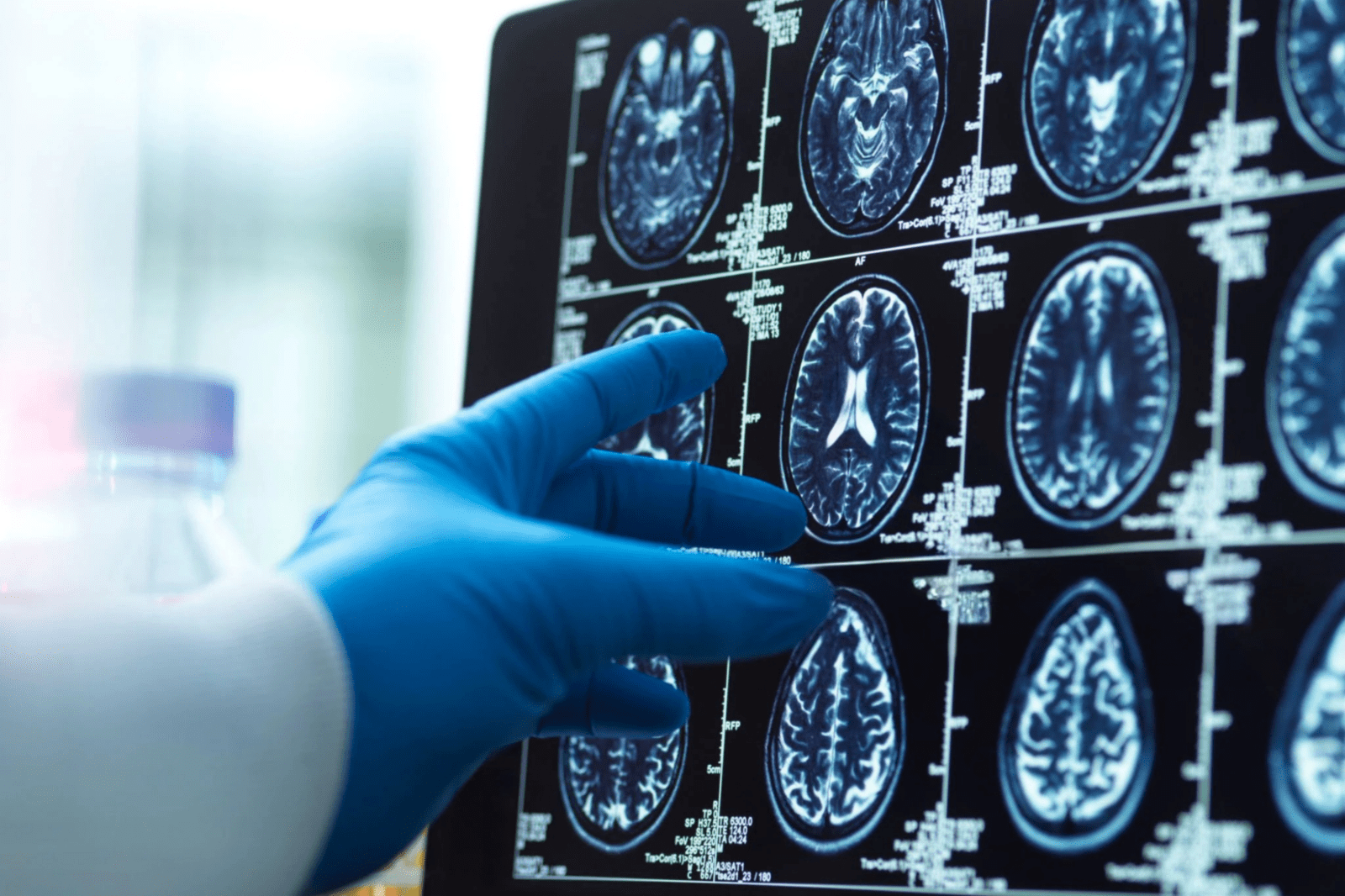 Scientists Discover a Protein Potentially Preventing Brain Changes from Alzheimer’s and Parkinson’s