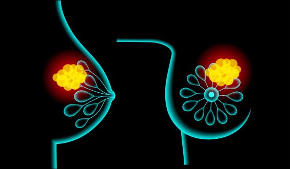 Breast Cancer Risk in Women with Negative BRCA Tests