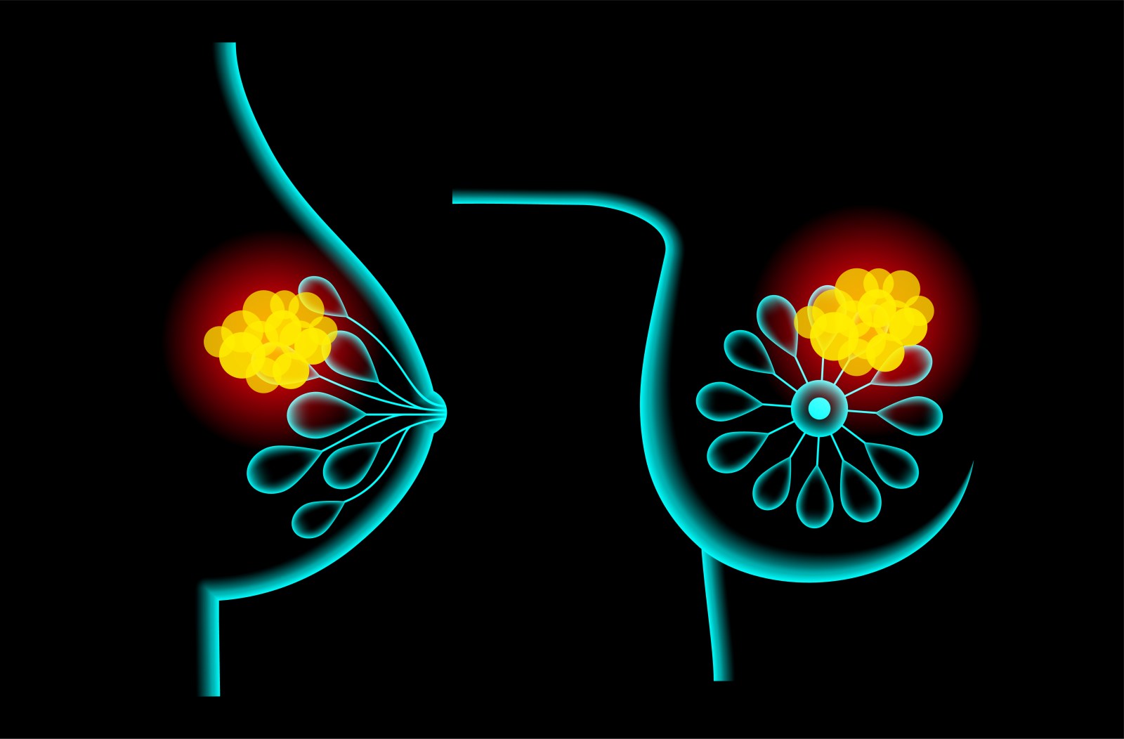 Breast Cancer Risk in Women with Negative BRCA Tests
