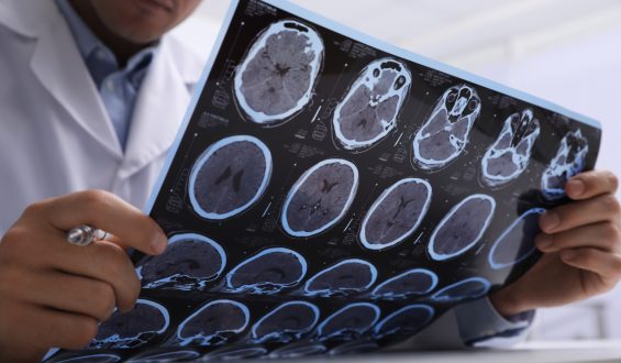 Early Life Sugar Reduction and Its Possible Impact on Alzheimer’s Risk