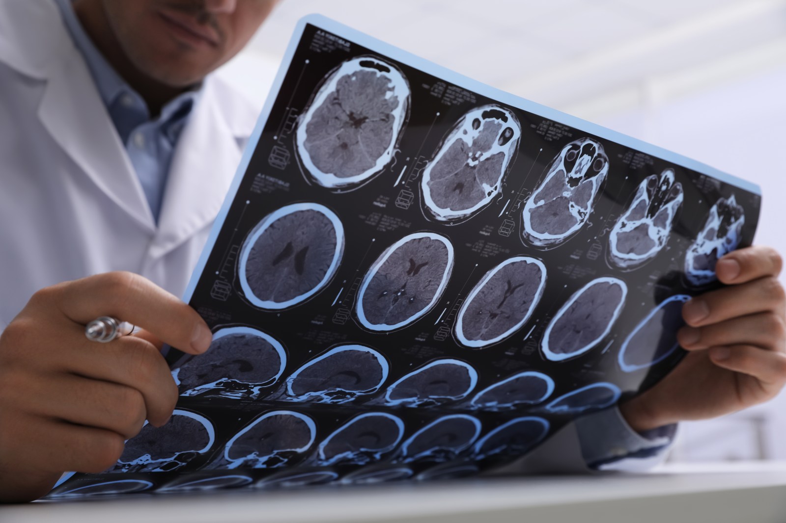 Early Life Sugar Reduction and Its Possible Impact on Alzheimer’s Risk