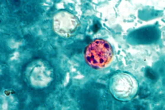 Widespread Cyclosporiasis Outbreak in 31 States