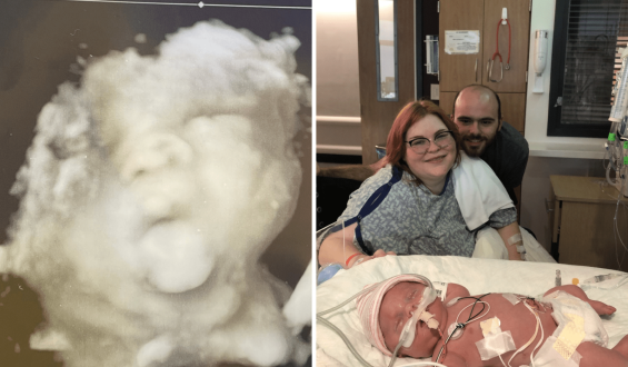 Facing Osteogenesis Imperfecta: One Mother’s Journey