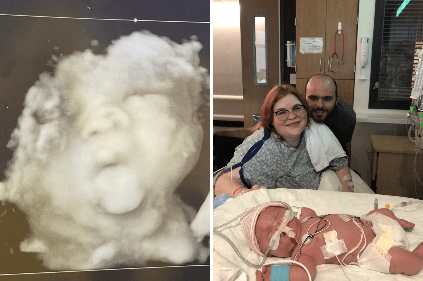 Facing Osteogenesis Imperfecta: One Mother’s Journey
