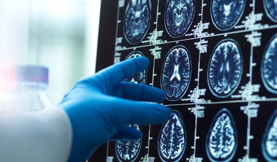 Mitochondrial Plaques: A New Discovery in Alzheimer’s Research