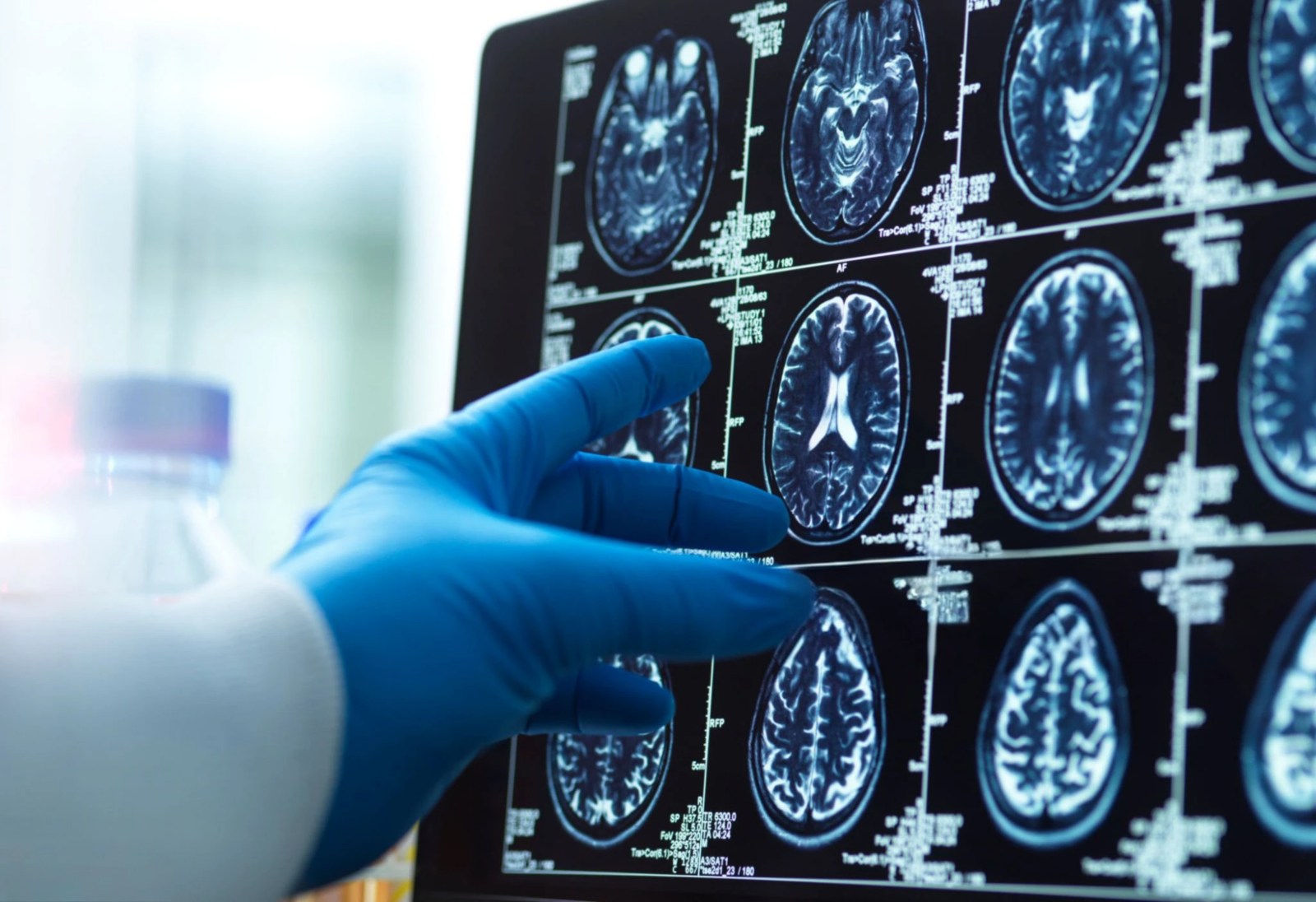 Mitochondrial Plaques: A New Discovery in Alzheimer’s Research