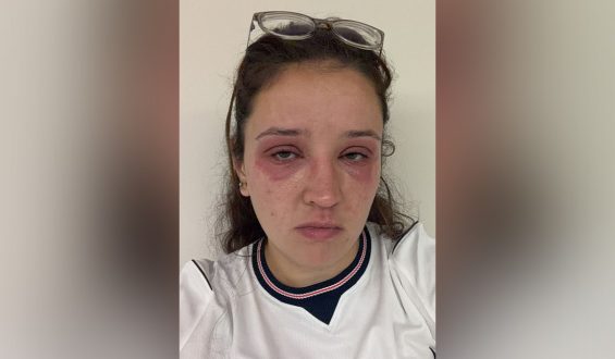 Bride-to-Be Warns of Allergic Reaction from Eyelash Extensions