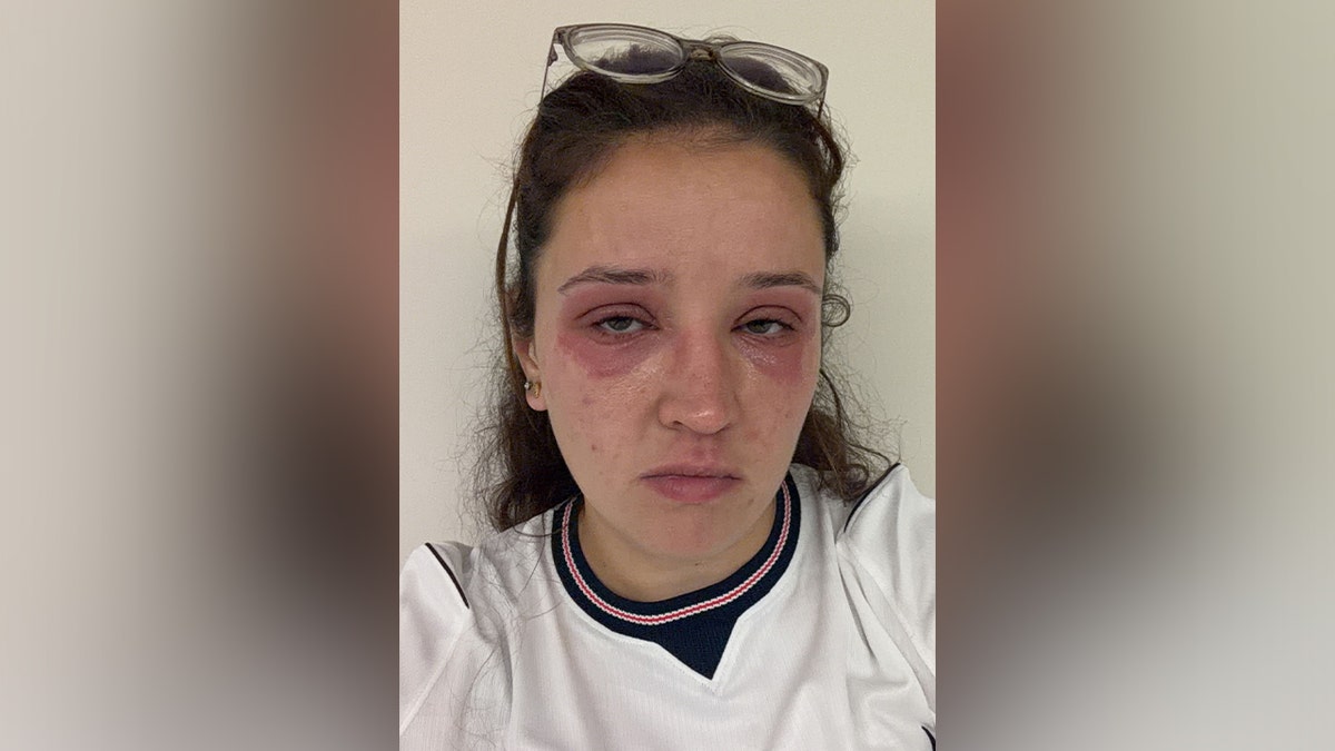 Bride-to-Be Warns of Allergic Reaction from Eyelash Extensions