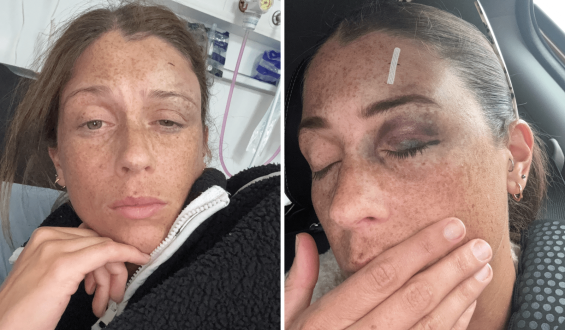 Woman Experiences Withdrawal Symptoms After Stopping Contraceptive Injection