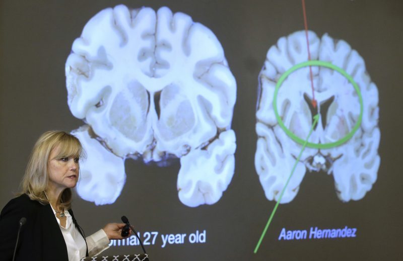 Study Shows One in Four Former NFL Players May Develop CTE