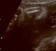 Legal Battle Over Surrogate Birth and Child’s Heart Surgery
