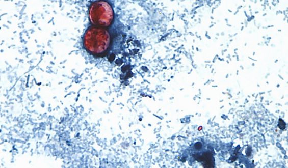 Cyclospora Outbreak Linked to Iceberg Lettuce in Fifteen States