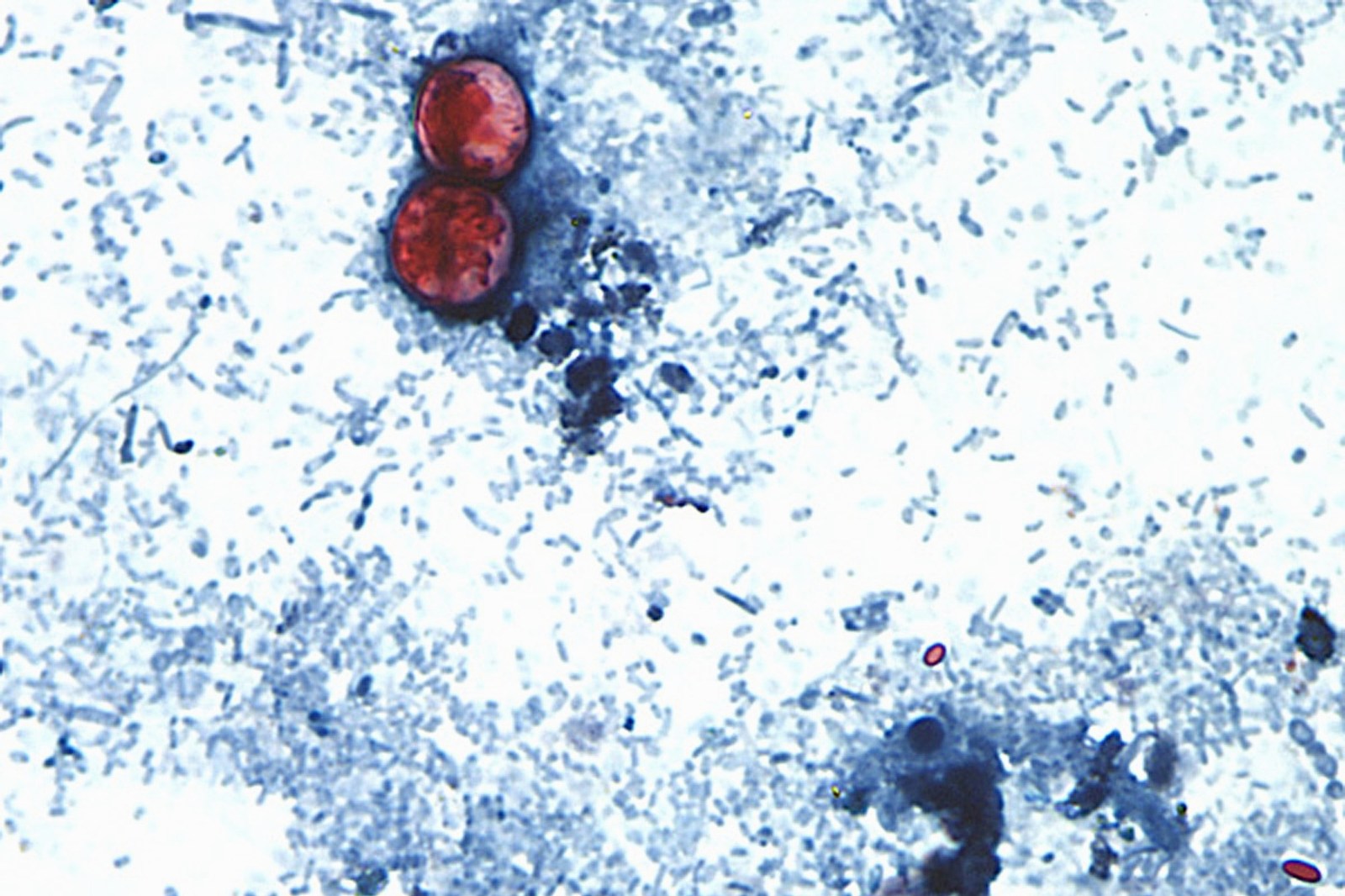 Cyclospora Outbreak Linked to Iceberg Lettuce in Fifteen States
