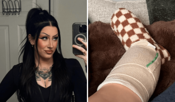 Young Woman’s Skin Cancer Experience Highlights Importance of Skin Checks