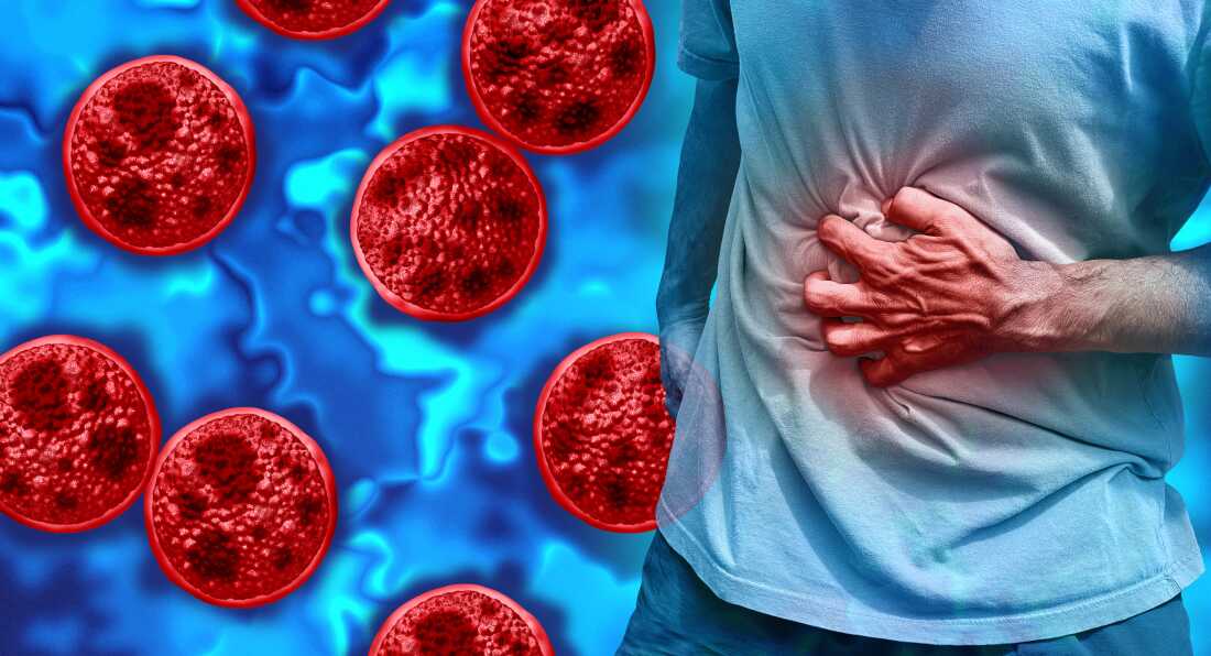 Cyclospora Outbreak: A Widespread Parasitic Challenge