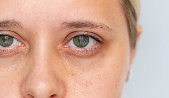 The Link Between Dark Under-Eye Circles and Low Iron Levels