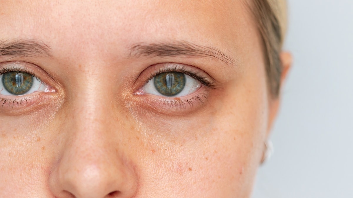 The Link Between Dark Under-Eye Circles and Low Iron Levels