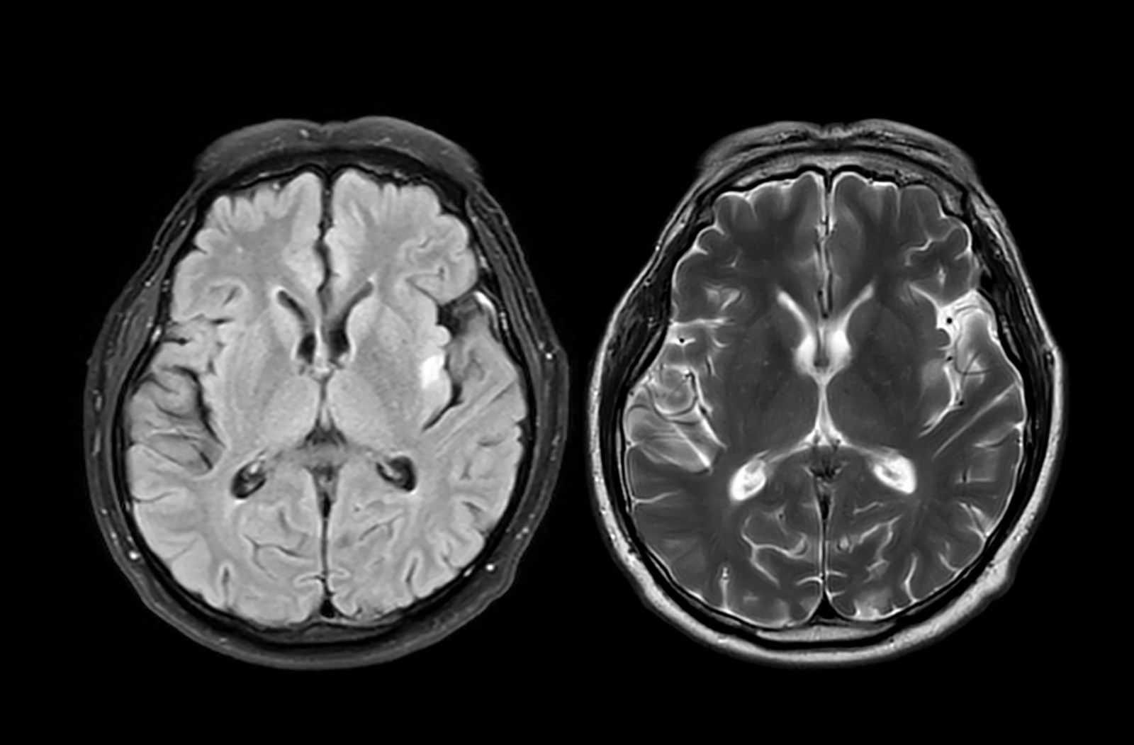 Early-Onset Alzheimer’s Progression Prediction Using Brain Scan Tool