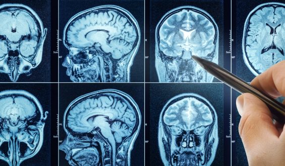 Addressing Lifestyle Risks May Reduce Dementia Cases