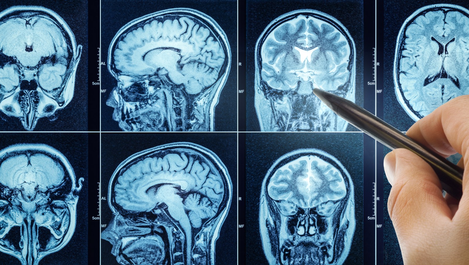 Addressing Lifestyle Risks May Reduce Dementia Cases