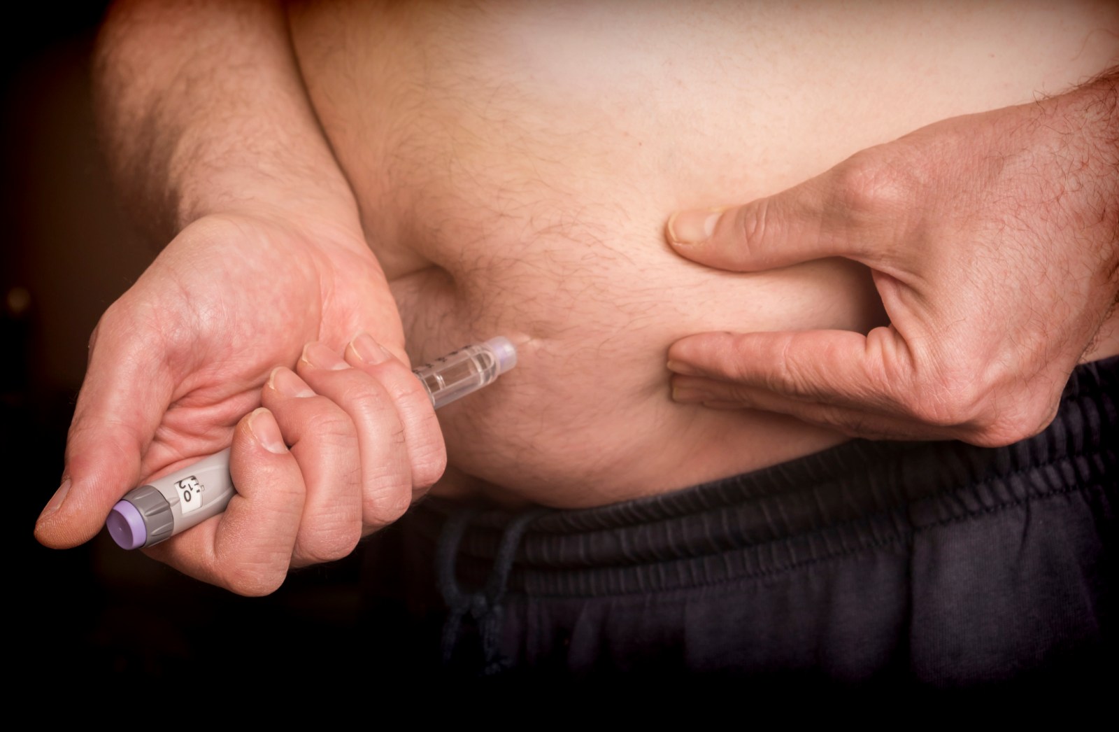 Weight-Loss Drugs and Hair Loss: New Genetic Evidence