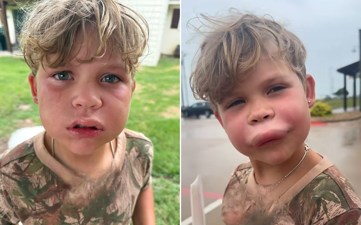 The Hidden Threat of Insect Stings: A Mother’s Experience