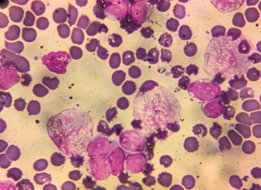 Infections as a Cause of Global Cancer: Prevention and Implications