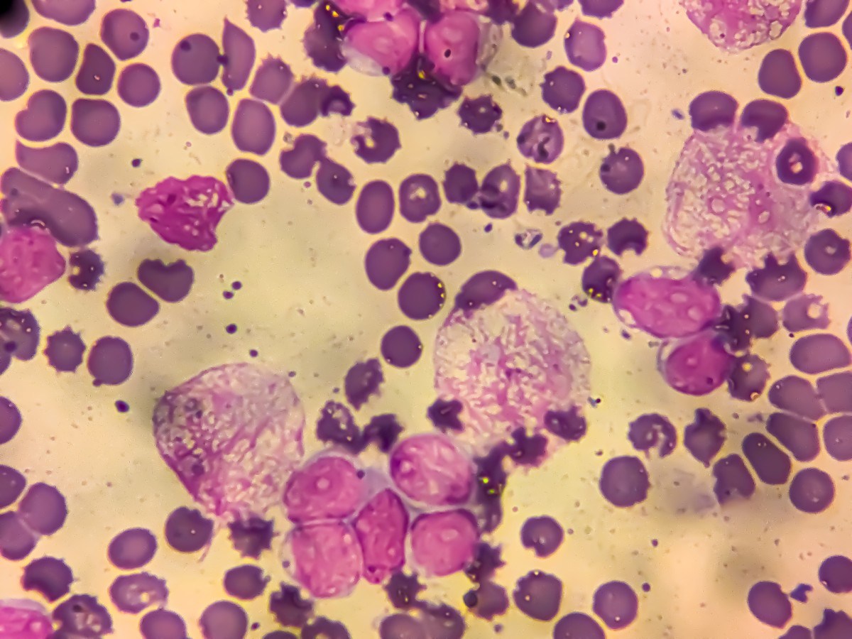 Infections as a Cause of Global Cancer: Prevention and Implications
