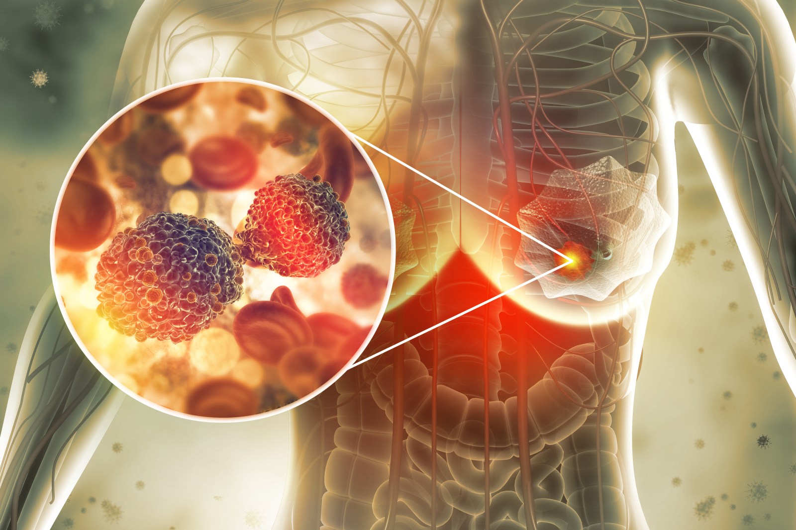 Understanding How Dense Breast Tissue Leads to Cancer