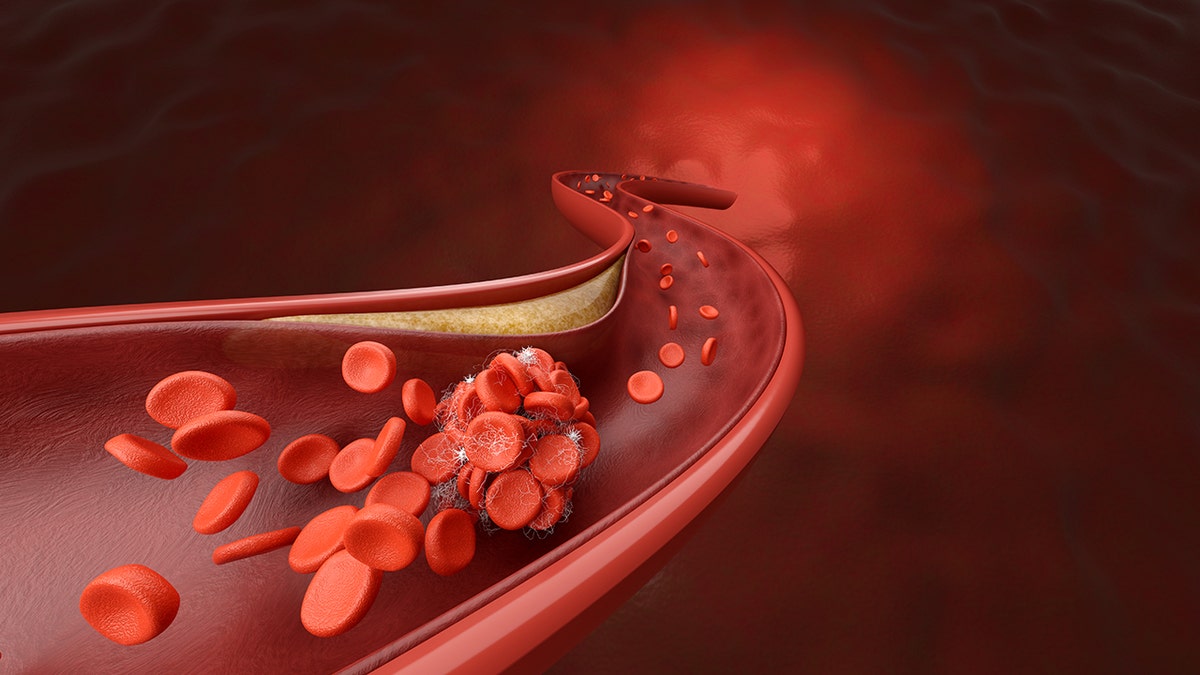 Starting Statin Therapy Early May Lower Dementia Risk for Diabetes Patients