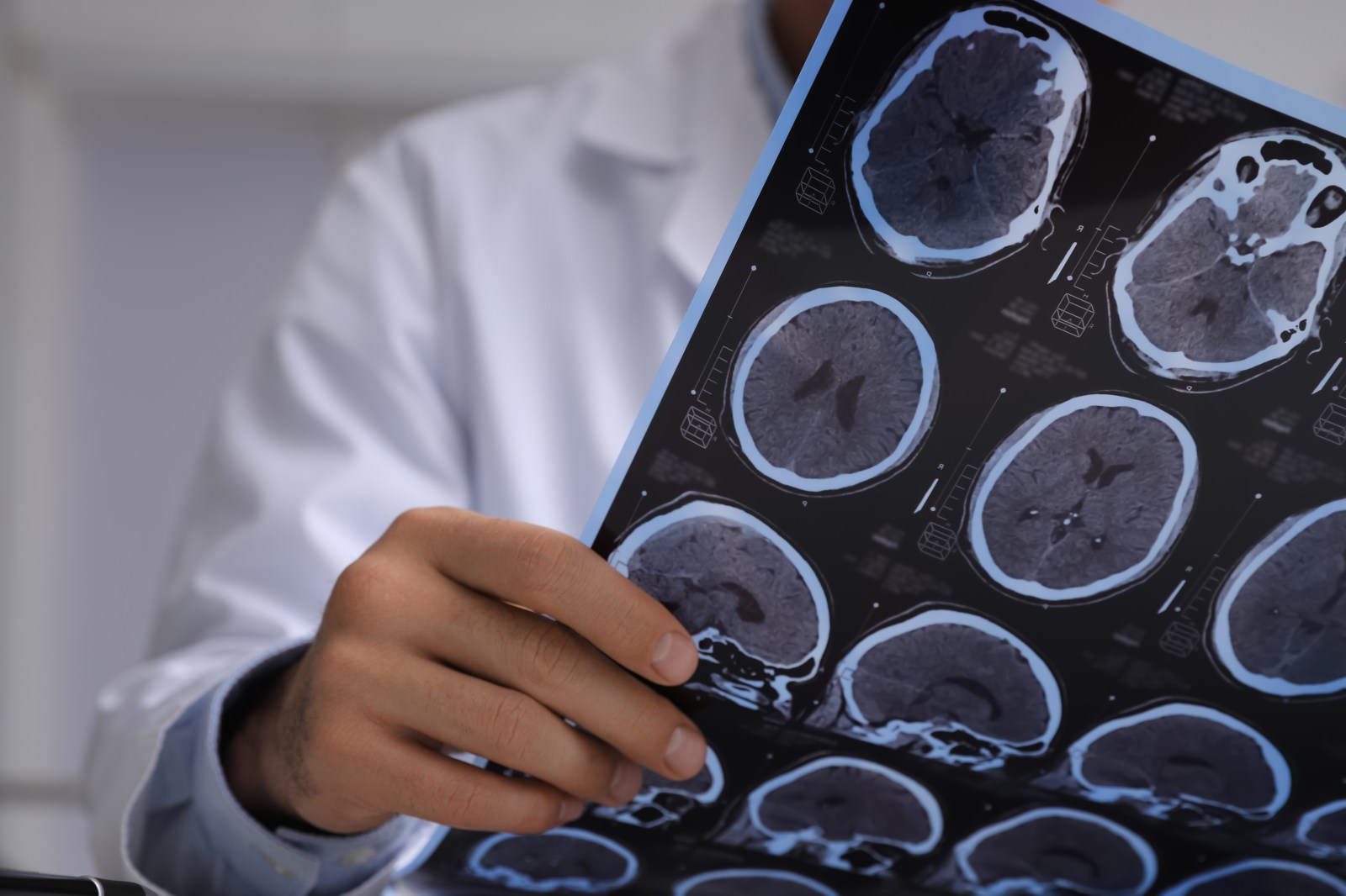 Brain Changes Occur Years Before Alzheimer’s Detection