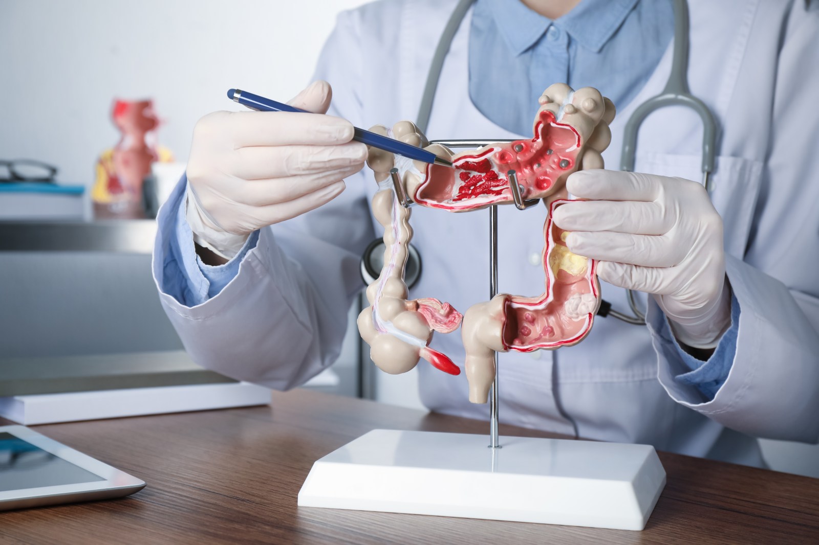 Differences in Early-Onset Bowel Cancer Among Younger Patients