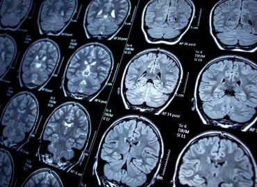 Researchers Identify Potential Immune Link to Alzheimer’s Disease