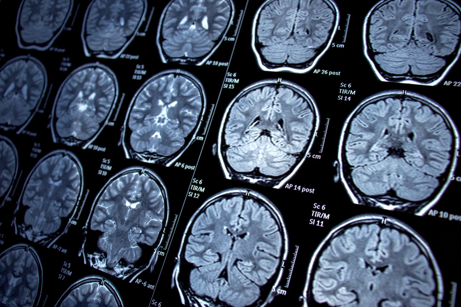Researchers Identify Potential Immune Link to Alzheimer’s Disease