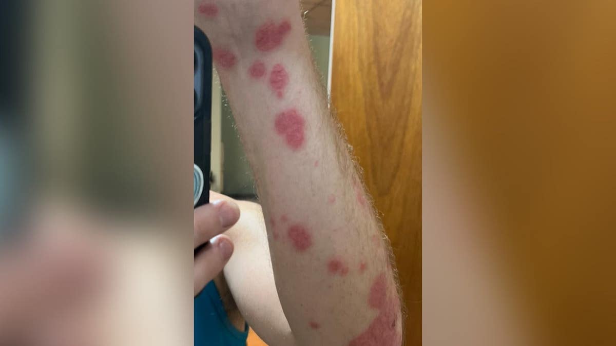 Florida Man Triumphs Over Psoriasis with Strict ‘Lion Diet’