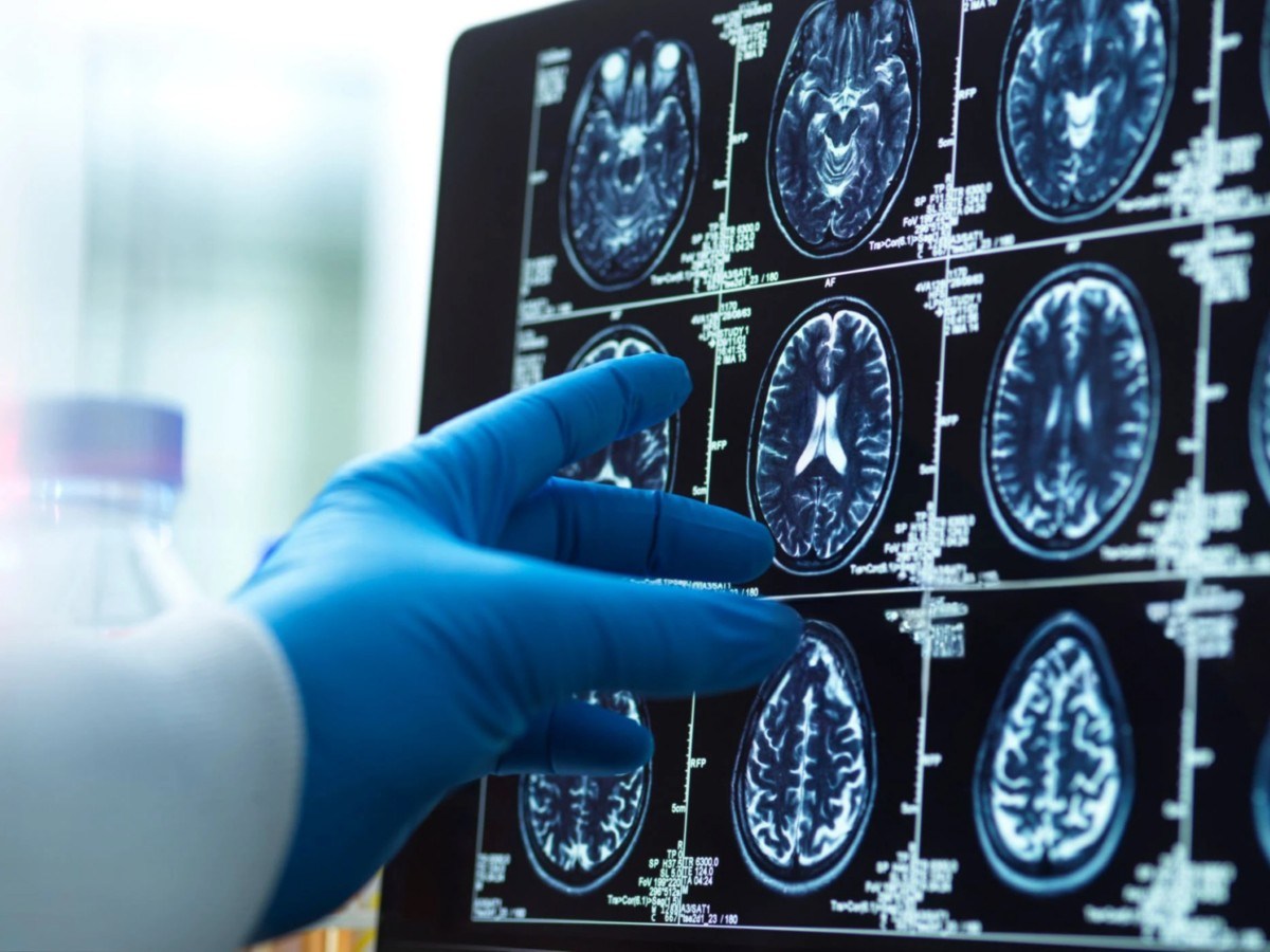 FDA Clears New Blood Test for Alzheimer’s Diagnosis