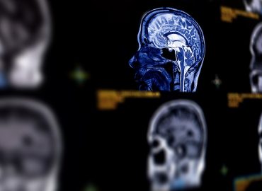 Understanding Menopausal Brain Fog and Cognitive Changes in Women