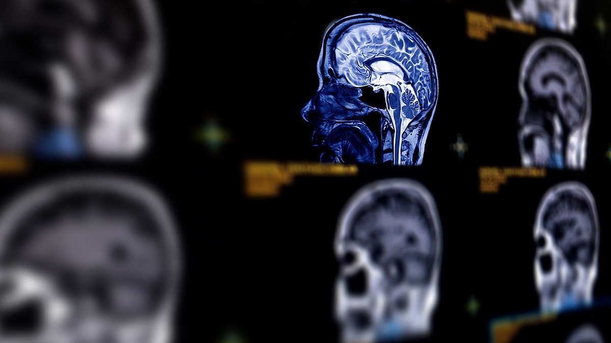 Understanding Menopausal Brain Fog and Cognitive Changes in Women