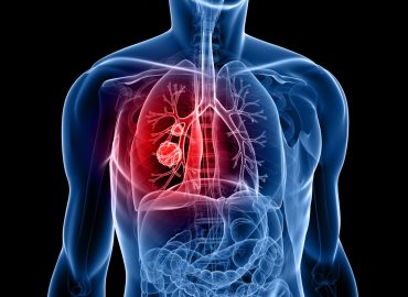 Genetic Mutation Significantly Increases Lung Cancer Risk