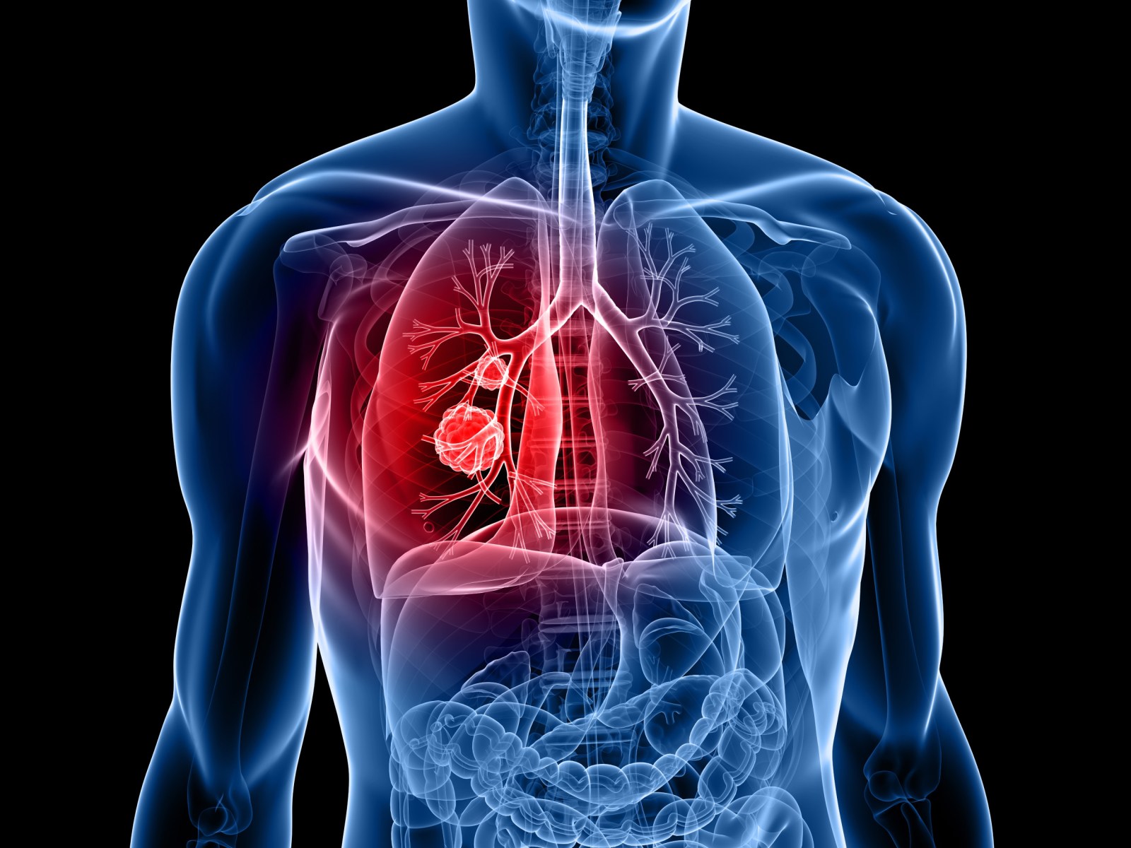 Genetic Mutation Significantly Increases Lung Cancer Risk