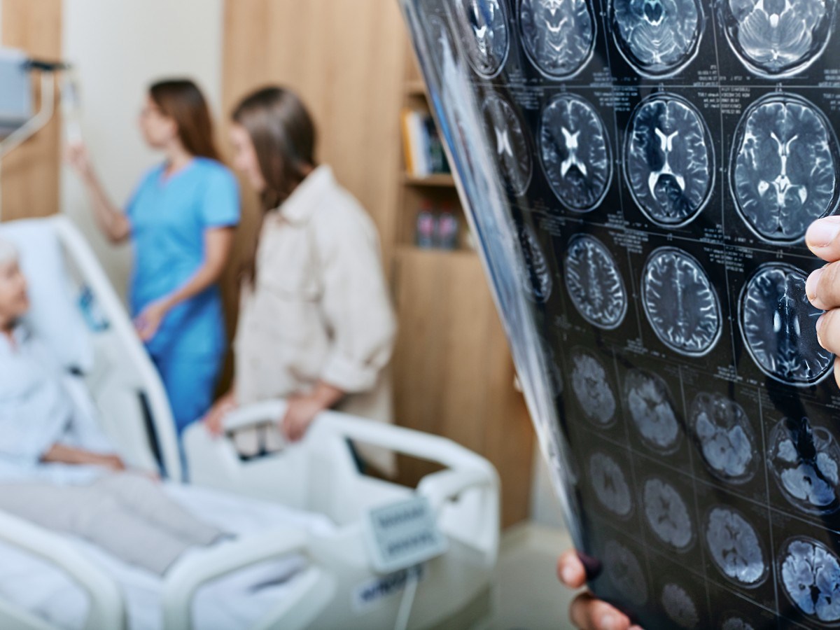 Increasing Stroke Risk Among Younger Adults: Insights and Prevention